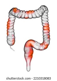 3d Rendered, Medically Accurate Illustration Of Colon Inflammation