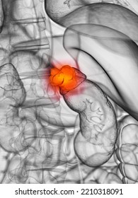 3d Rendered, Medically Accurate Illustration Of Adrenal Gland Cancer