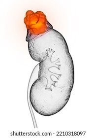 3d Rendered, Medically Accurate Illustration Of Adrenal Gland Cancer