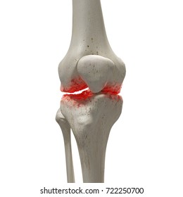 3d Rendered Medically Accurate Illustration Of An Arthritic Knee