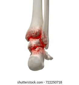 3d Rendered Medically Accurate Illustration Of An Arthritic Ankle