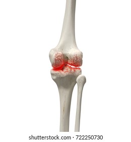 3d Rendered Medically Accurate Illustration Of An Arthritic Knee