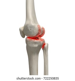 3d Rendered Medically Accurate Illustration Of An Arthritic Knee