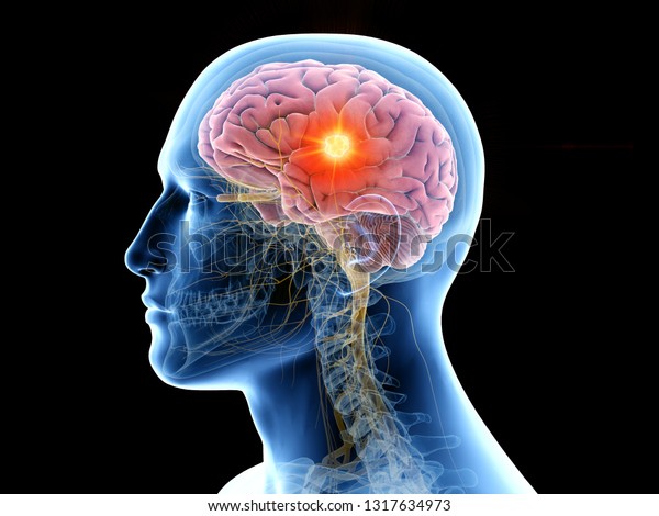 3dで 人間の脳と腫瘍の医学的に正確なイラストを描いた のイラスト素材