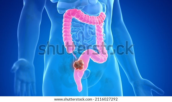 3d rendered medically accurate illustration of\
colon cancer