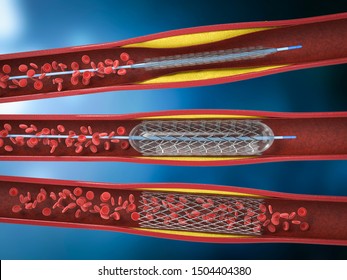 3d rendering balloon angioplasty procedure with stent in vein 