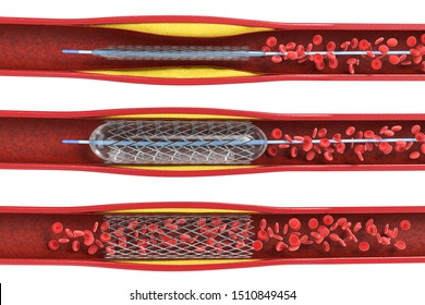 3d rendering balloon angioplasty procedure with stent in vein isolated on white