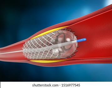 3d rendering balloon angioplasty procedure with stent in vein 