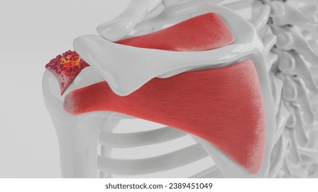 3D Rendering of Calcific Tendonitis in the Shoulder