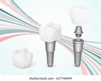 X Ray View Denture Implant Xray Stock Illustration 545431282 | Shutterstock