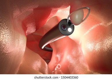 3d rendering endoscope remove colonic polyp with wire loop