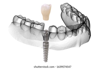 3D Rendering Implant Model Jaw