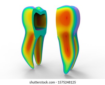 3D rendering - tooth implant analysis