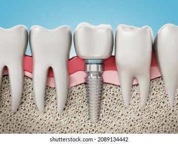 3D rendering of tooth implant showing jaw gum and bone layers. 3D illustration.