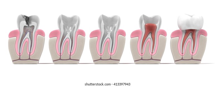 3d Renderings Of Endodontics - Root Canal Procedure