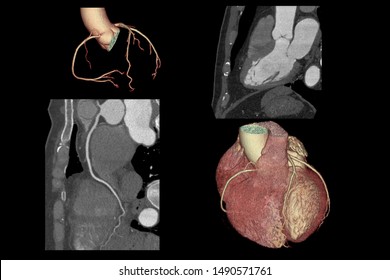 3D SCAN CTA Coronary Artery, Coronary Tree With Long Axis View And Vessel Trace.