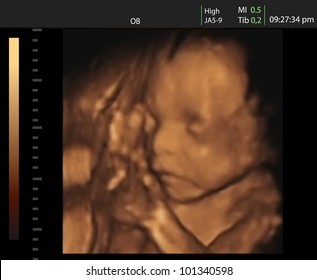3D ultrasound of baby in mother's womb.