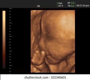 3D Ultrasound Of Baby In Mother's Womb.