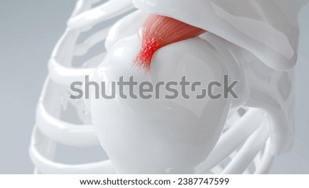 3D visualization of a shoulder with calcific tendinitis, highlighting inflammation.