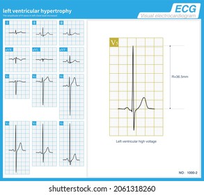 A 51 Year Old Man Was Clinically Diagnosed With Leukemia. ECG Showed Left Ventricular Hypertrophy, Magnetic Resonance Confirmed Ventricular Septal Thickening And Leukemia Cell Infiltration.