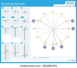 A 51 Year Old Man Was Clinically Diagnosed With Leukemia. ECG Showed Left Ventricular Hypertrophy, But The Frontal Axis Was Normal At + 78 Degrees.