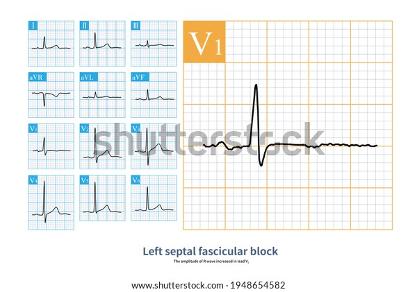 59 Year Old Man Diagnosed Coronary Stock Illustration 1948654582 ...