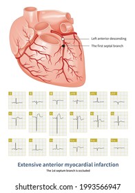 211 Left anterior descending branch Images, Stock Photos & Vectors ...