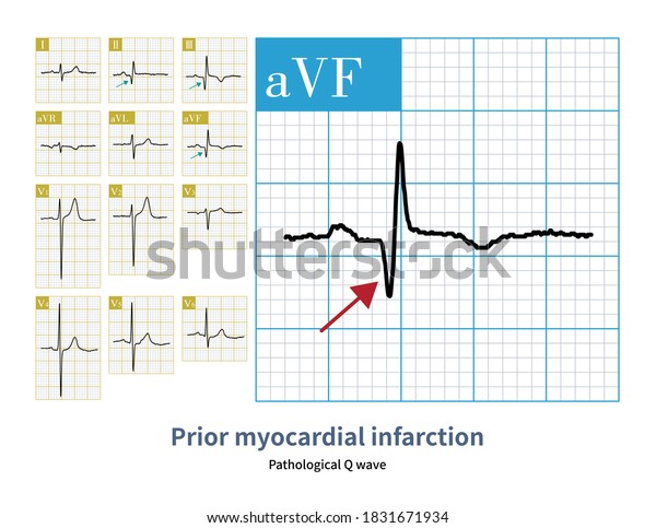 63yearold Male Who Suffered Myocardial Infarction Stock Illustration ...