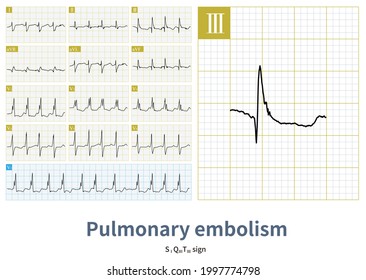 A 68 year old woman was diagnosed with acute massive pulmonary embolism. ECG showed atrial fibrillation, right axis deviation, complete right bundle branch block combined with RVH.