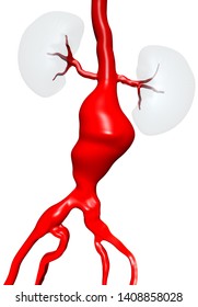 Abdominal aortic aneurysm (AAA) located below the arteries that supply blood to the kidneys by renal artery. 3D illustration.