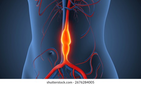 Abdominal Aortic Aneurysm causing vessel enlargement 3d illustration
