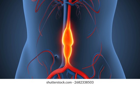 Abdominal Aortic Aneurysm causing vessel enlargement 3d illustration