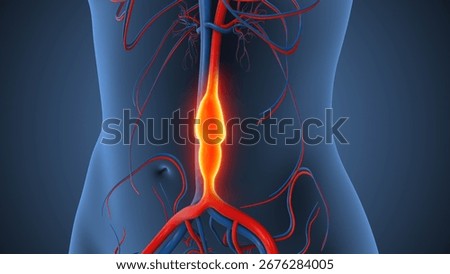 Abdominal Aortic Aneurysm causing vessel enlargement 3d illustration