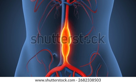 Abdominal Aortic Aneurysm causing vessel enlargement 3d illustration