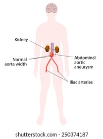 Abdominal Aortic Aneurysm. Human Kidney And Aorta. Silhouette Of A Man.