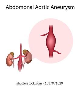 Abdominal Aortic Aneurysm Widening Vessel Medical Stock Illustration ...