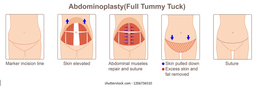 abdominoplasty,full tummy tuck