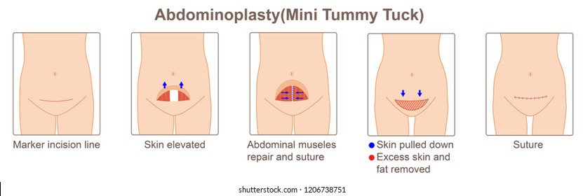 abdominoplasty,mini tummy tuck
