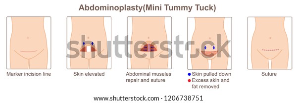 abdominoplasty,mini tummy\
tuck