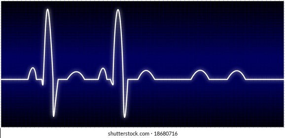 Abnormal EKG (AV Block)