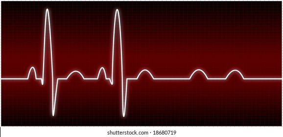 Abnormal EKG (AV Block)