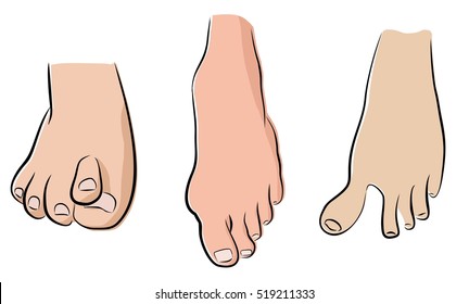 abnormal feet