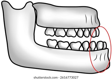 Abnormal jawbone structure with protruding lower jaw causing an underbite
