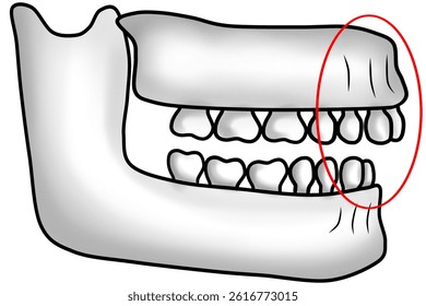 Abnormal jawbone structure with protruding upper jaw causing an overbite