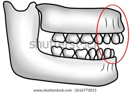 Abnormal jawbone structure with protruding upper jaw causing an overbite