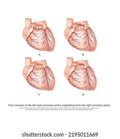 The Abnormal Left Coronary Artery Originates From The Right Coronary Sinus, And The Abnormal Course Of Blood Vessels Is The Cause Of Sudden Death Of Some Patients During Exercise.