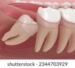 Abnormal position of wisdom teeth. Medically accurate tooth 3D illustration