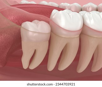 Abnormal position of wisdom teeth. Medically accurate tooth 3D illustration