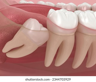 Abnormal position of wisdom teeth. Medically accurate tooth 3D illustration