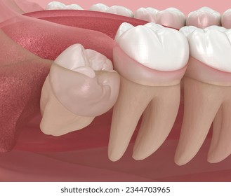 Abnormal position of wisdom teeth. Medically accurate tooth 3D illustration